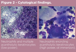 The Use of HCA in Pemphigus Foliaceus